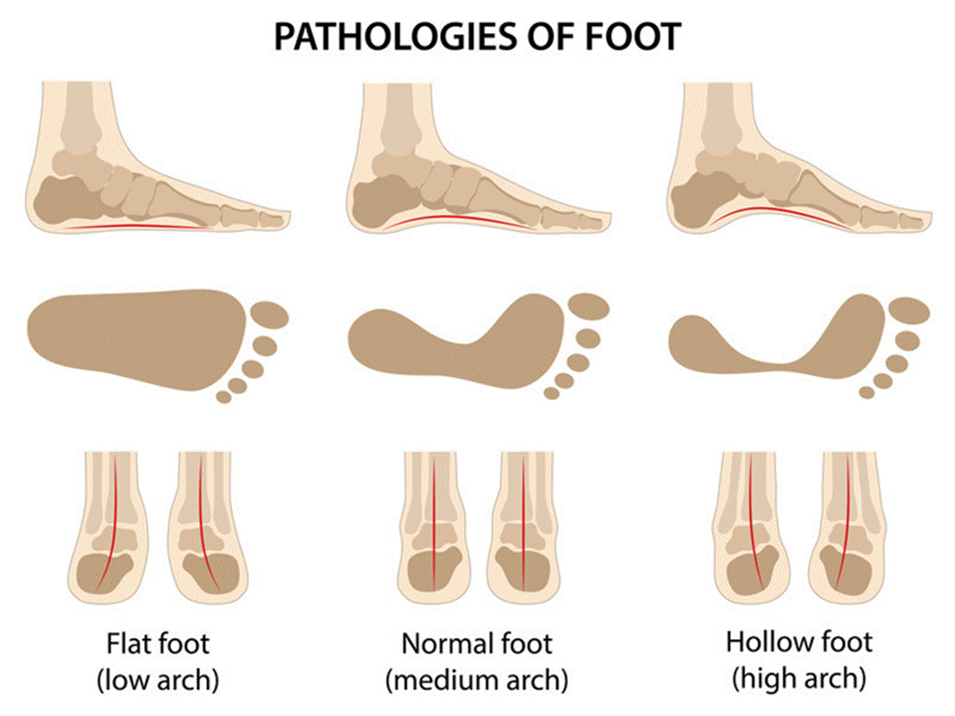 Foot Types Comparison Comparison of normal, flat, and high arch foot types