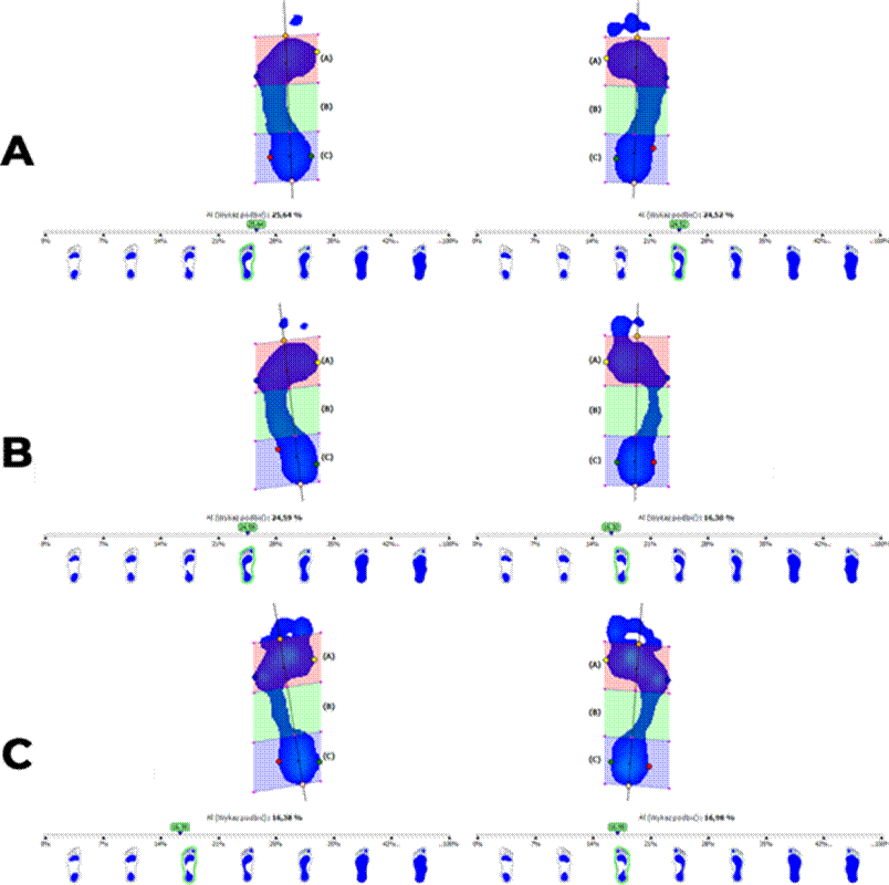Plantar Pressure Distribution Detailed plantar pressure distribution analysis