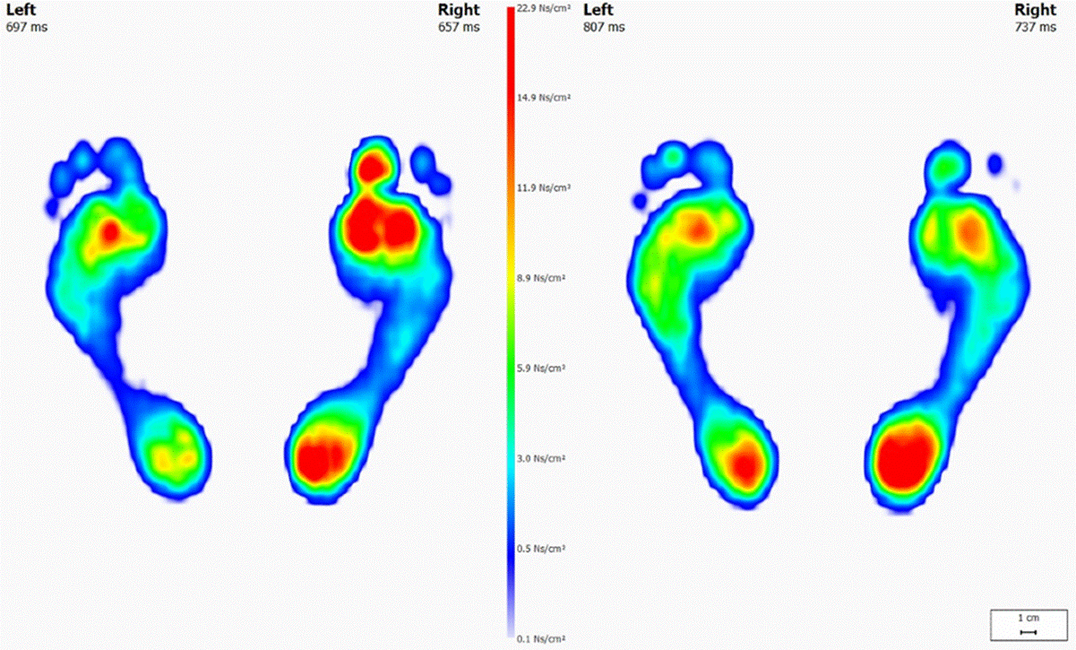 Gait Analysis Scan Foot scan used for gait analysis